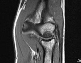 Capitellar OCD MRI